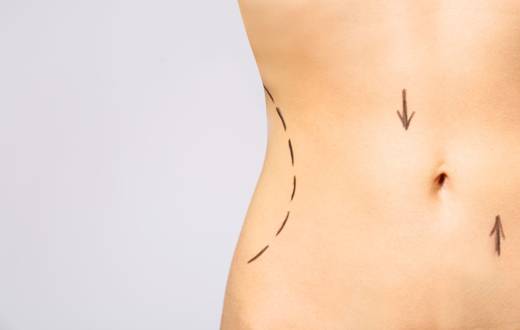Differences Between Liposuction and Laser Liposuction2
